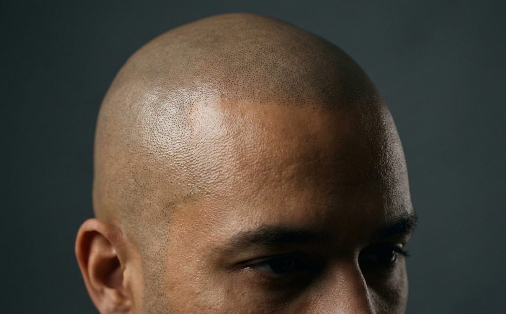 Scalp Micropigmentation (SMP)