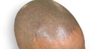 Male pattern baldness