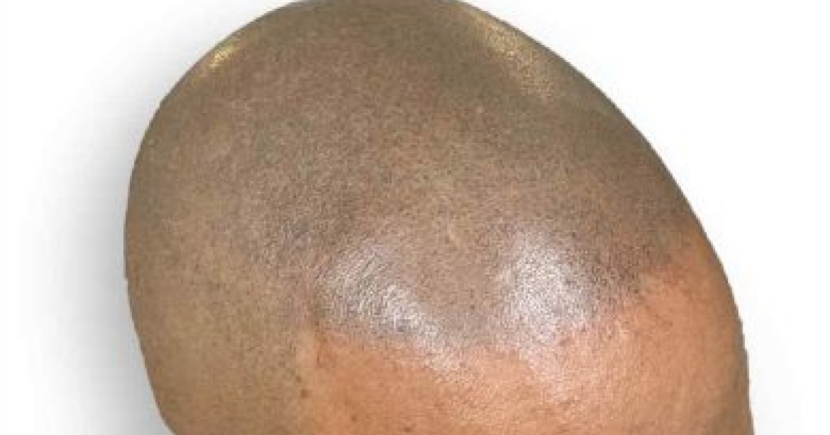 Male pattern baldness
